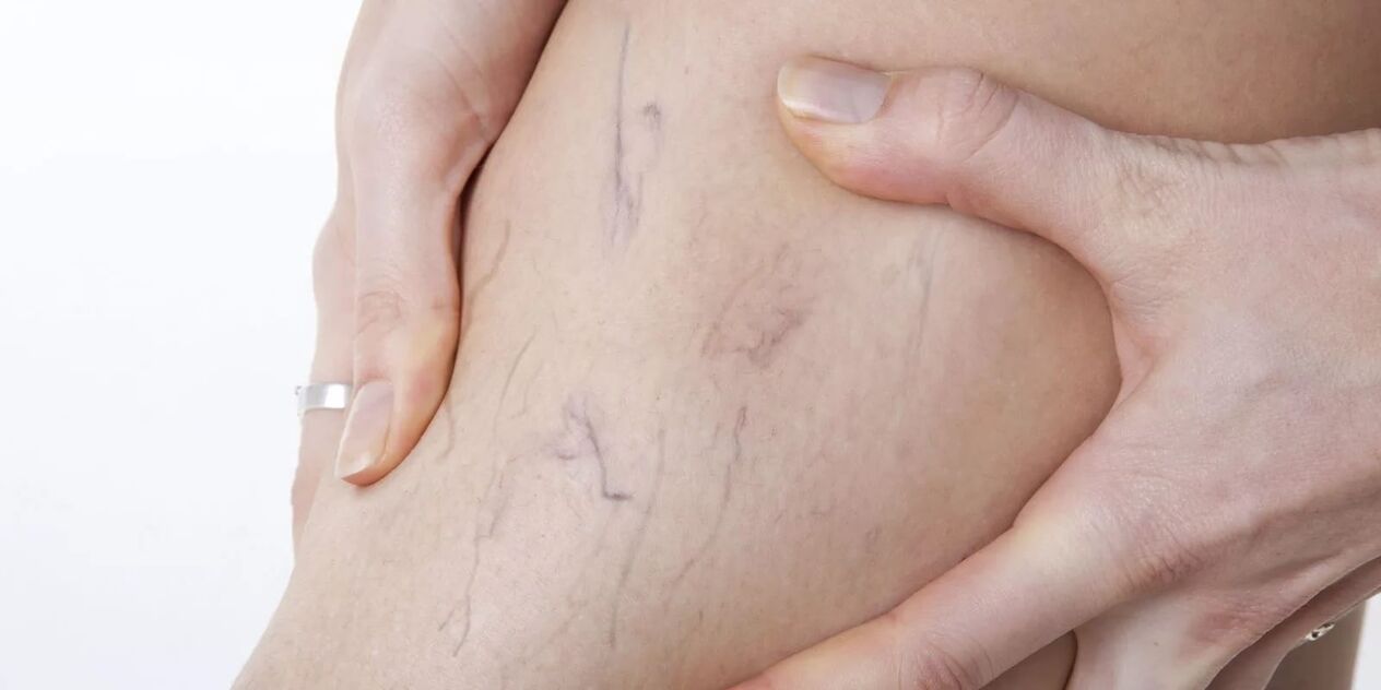 Before the use of varicons cream