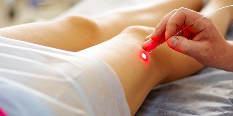 The endovenous laser vein coagulation procedure for varicose veins.