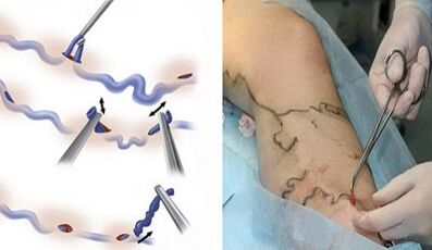 Flebectomy for varicose veins in the legs