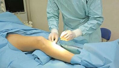 How an operation is carried out with varicose veins