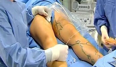 Operation for varicose veins