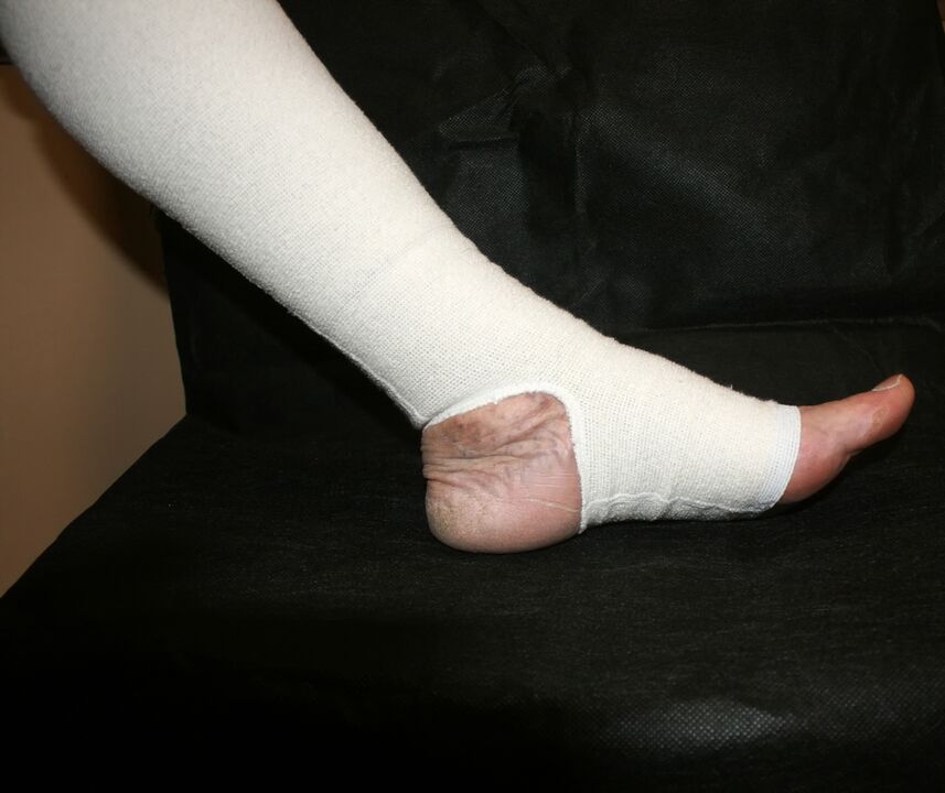 Compression point garments for varicose veins