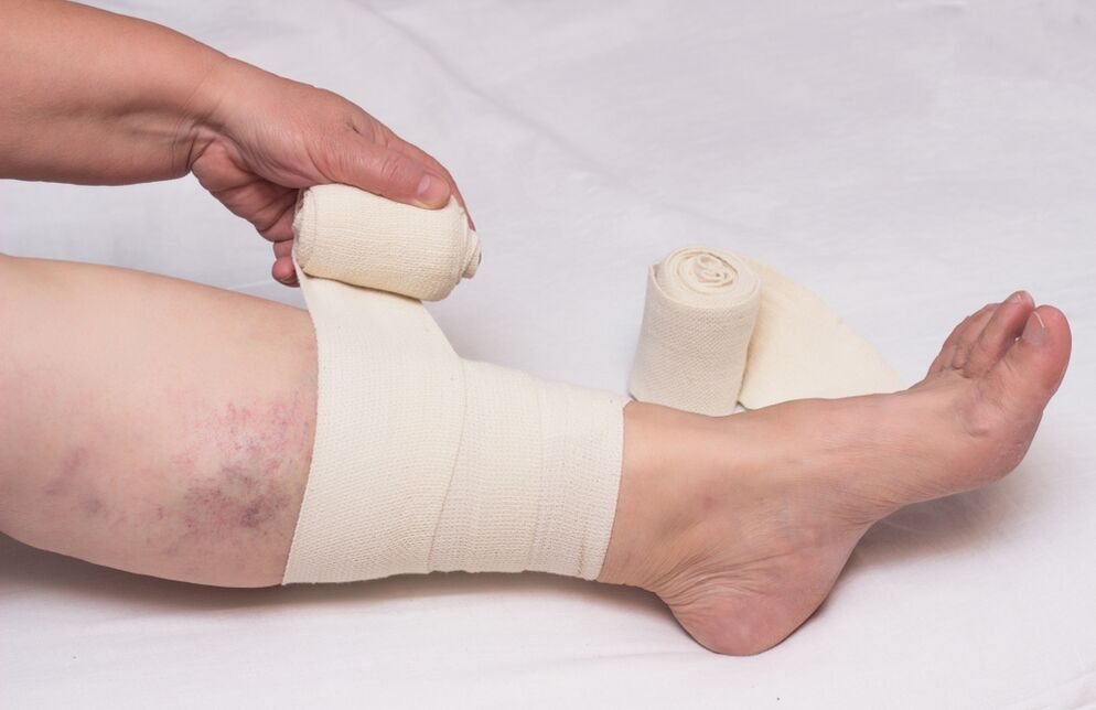 Compression treatment of varicose veins