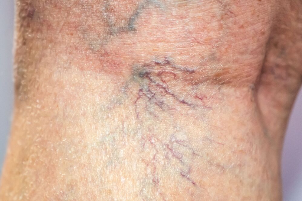 varicose veins